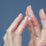 Puchýřky na prstech – co je způsobuje a jak je léčit
